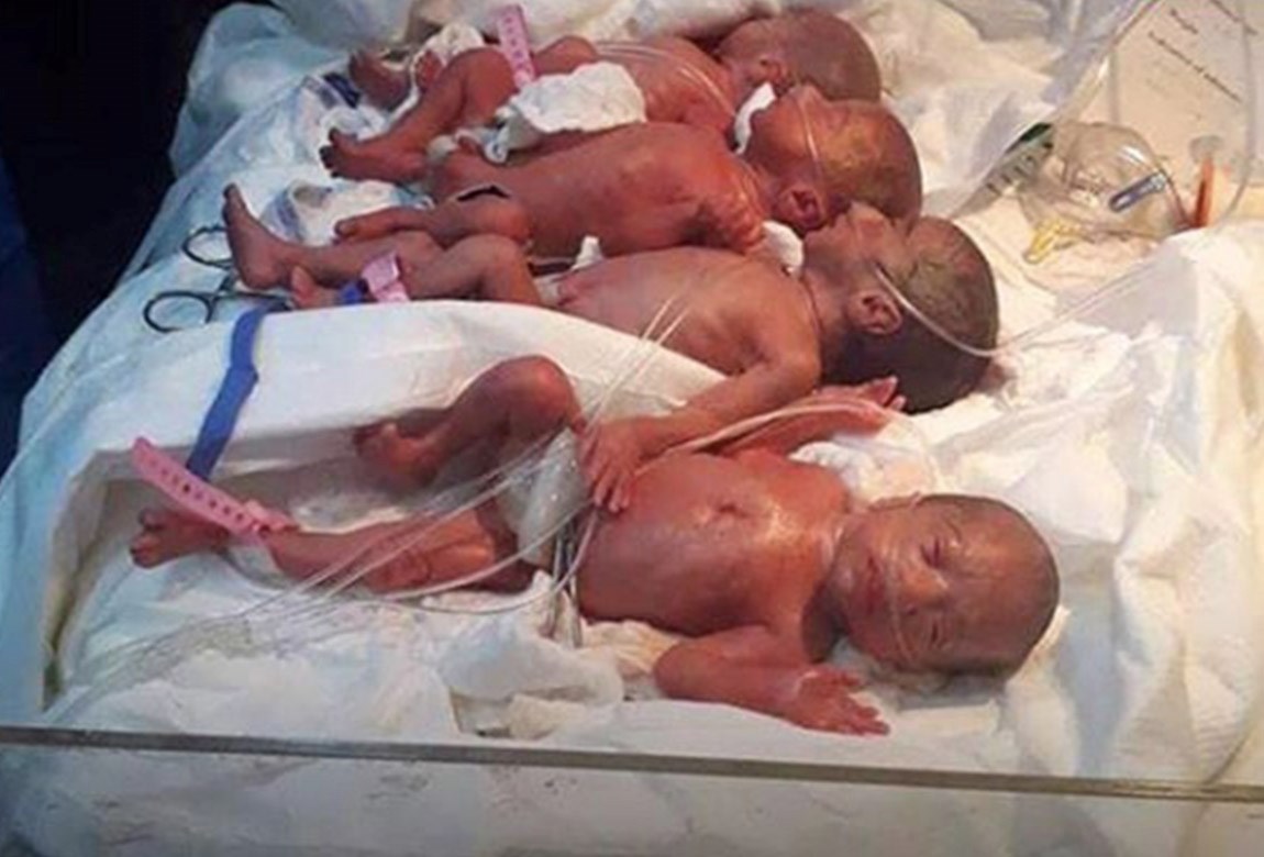 pregnant women with sextuplets